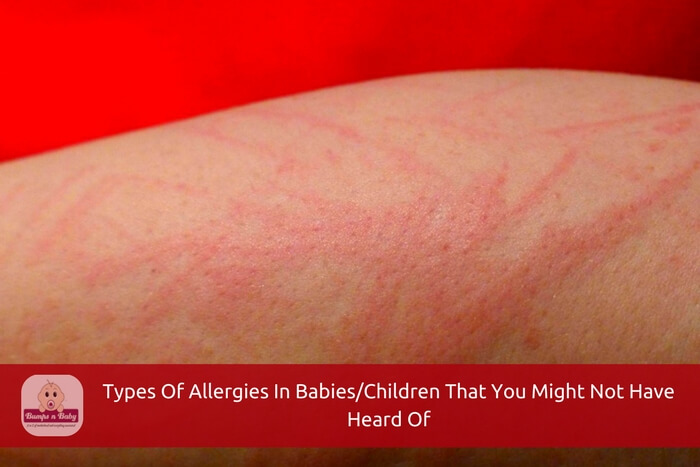 types of baby allergies