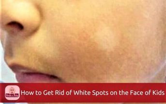 how to get rid of white spots on the face